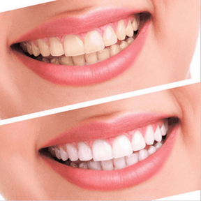 [3-Pack] White Bright - Now Teeth Whitening Changes Forever